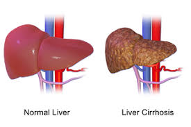 liver__cirrhosis